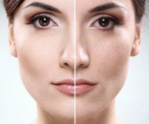 peeling-quimico doctora francisca signes